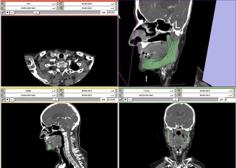 Mandible Bone 3D Printer Model